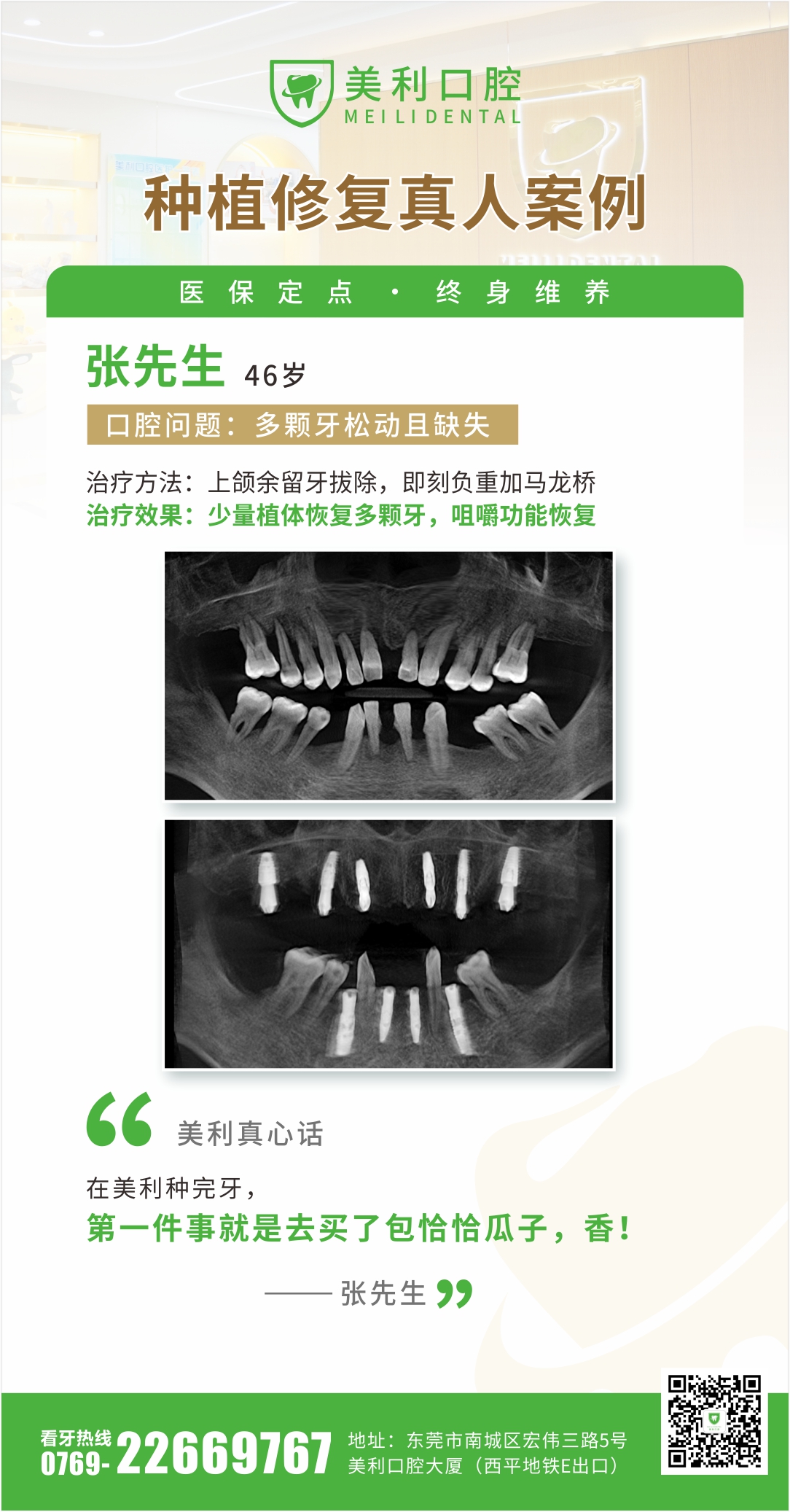 种植修复案例