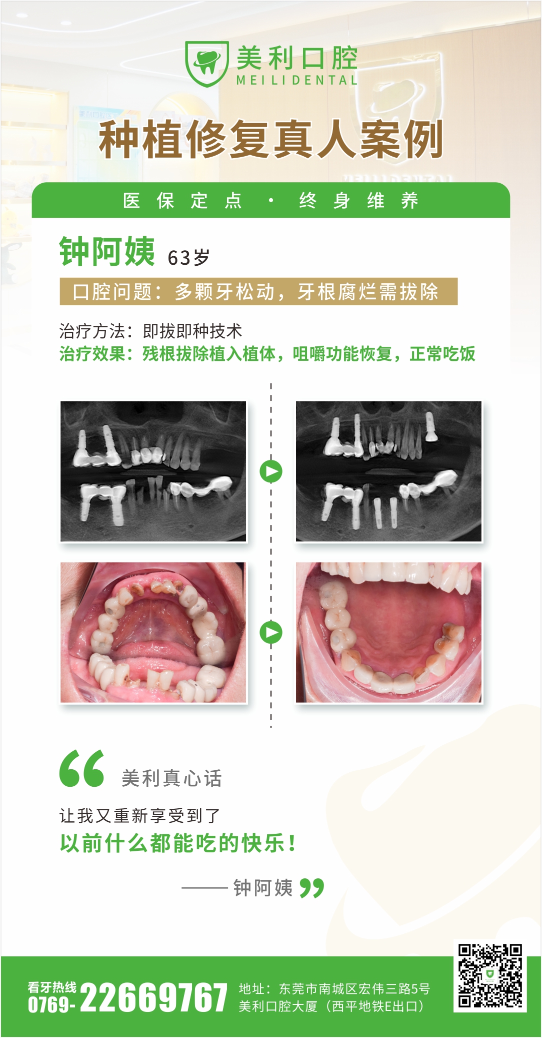 种植修复案例