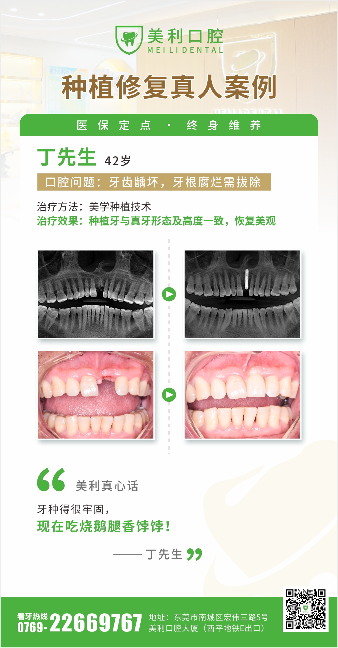 种植修复案例