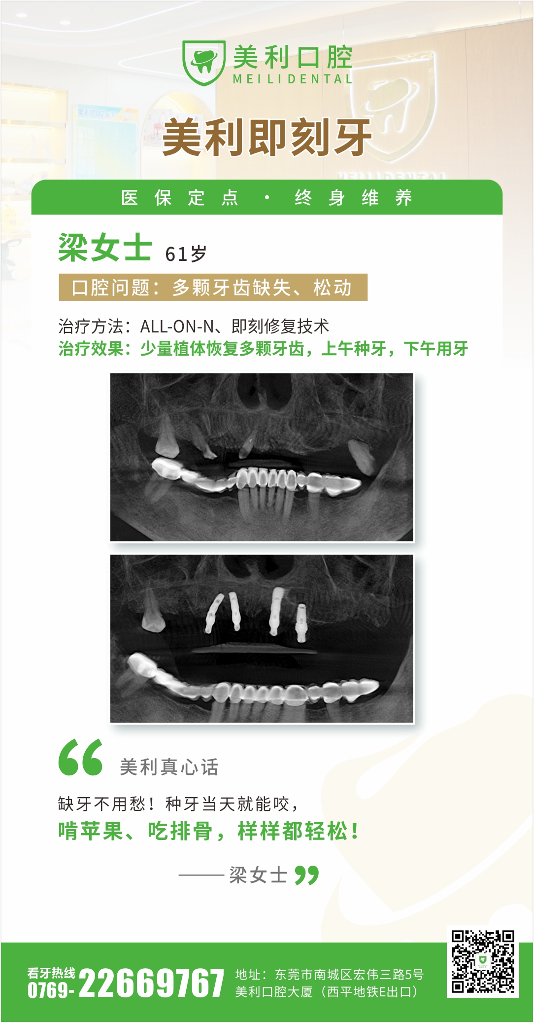 即刻种植案例