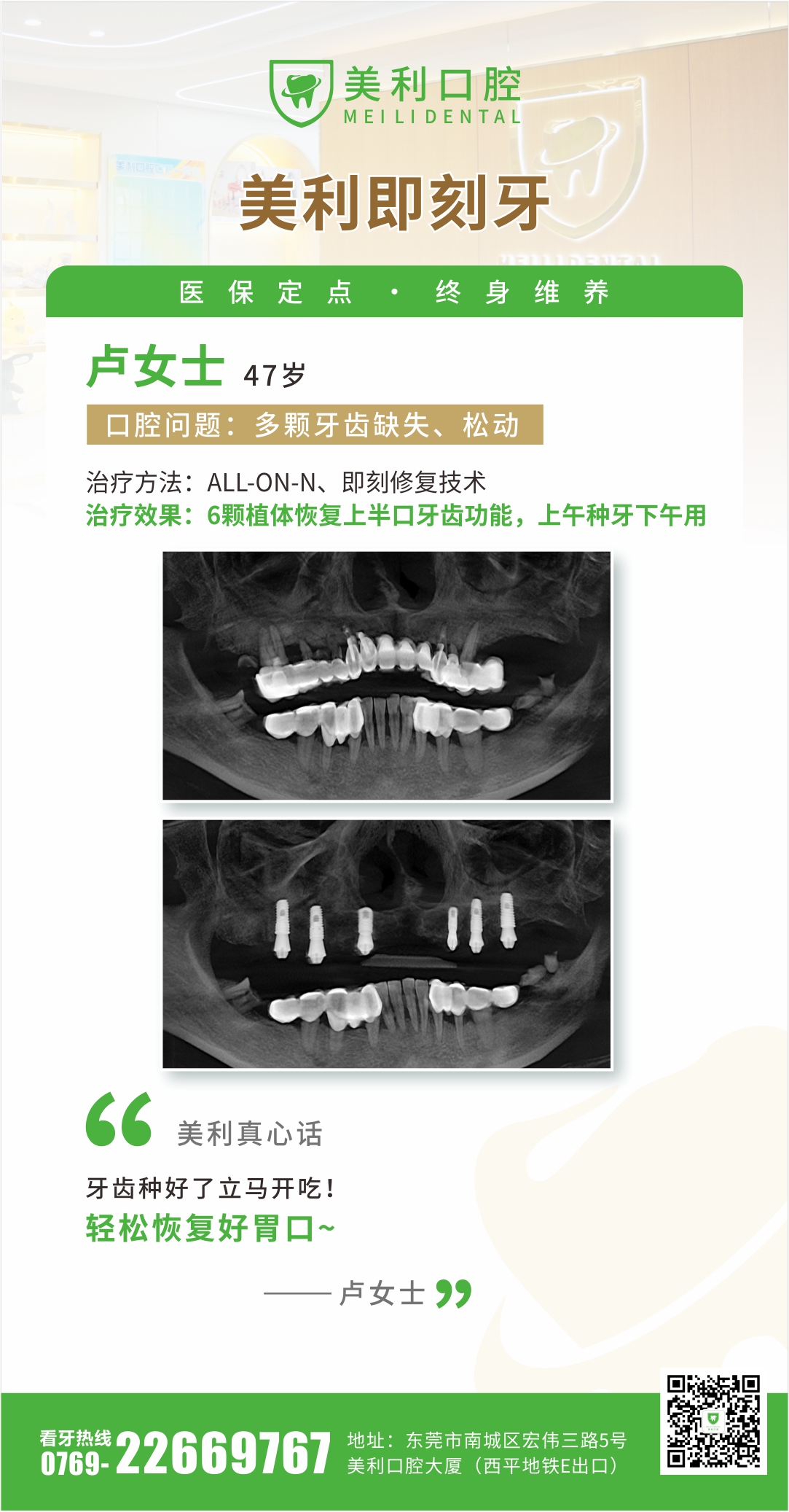即刻种植案例