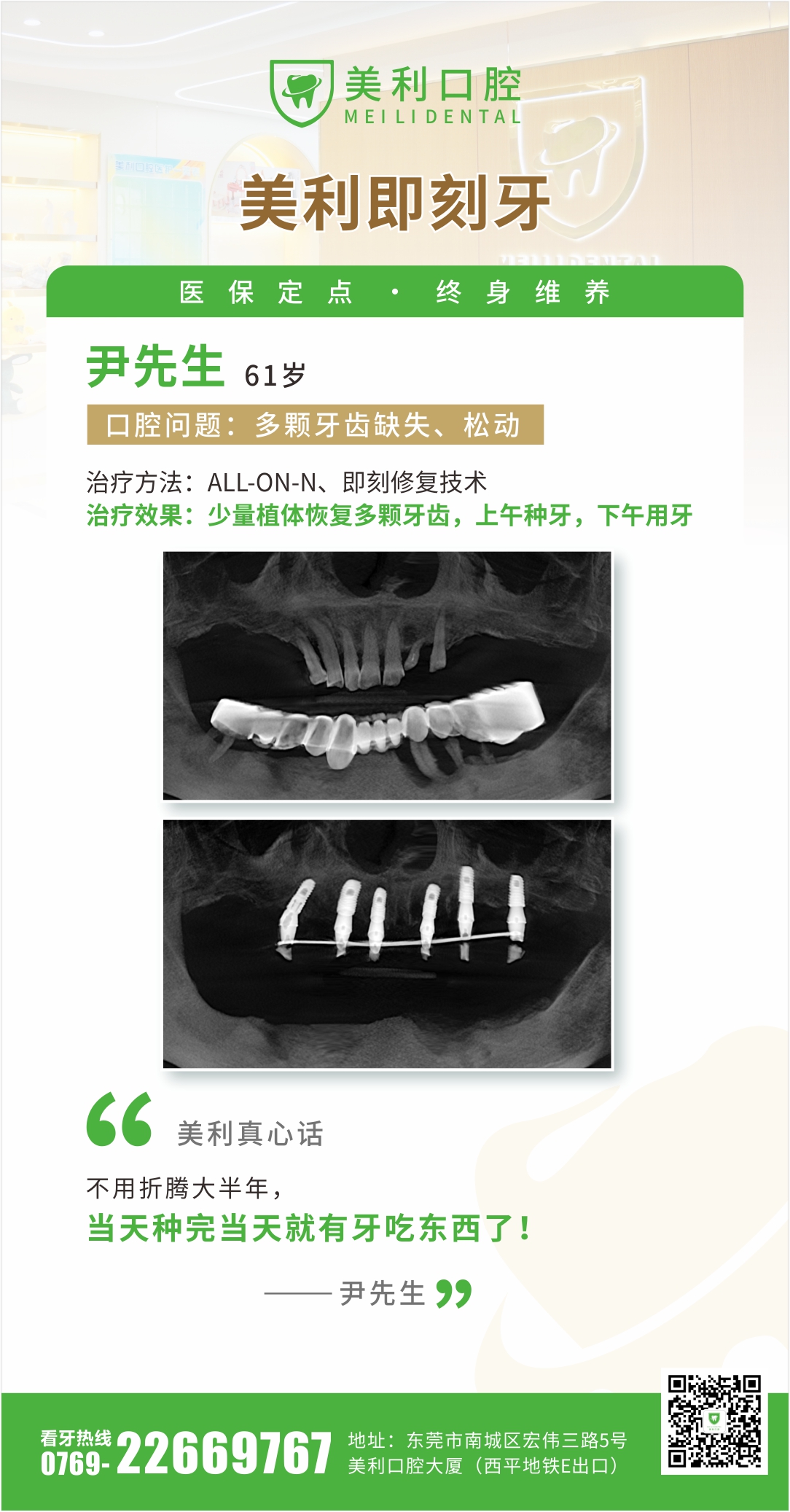 即刻种植案例